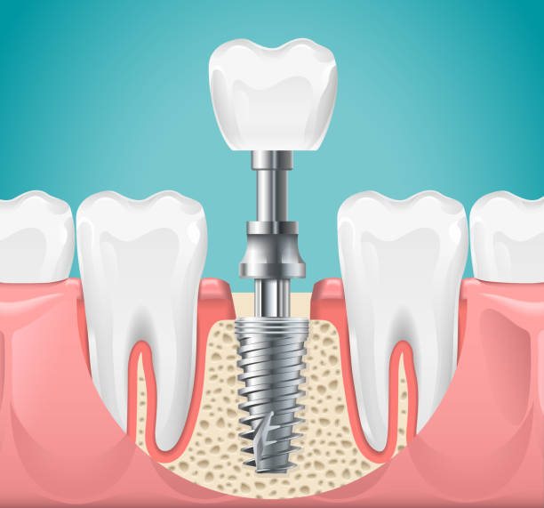 Quy trinh trong rang implant ban nen biet